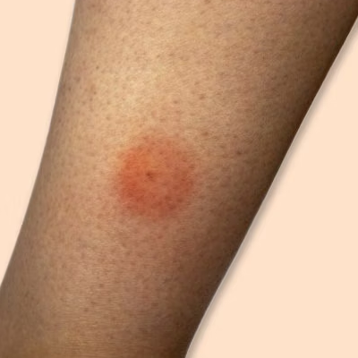 Infected Bites & Stings